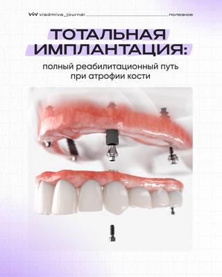 Восстановление верхней челюсти: имплантаты Medentika.